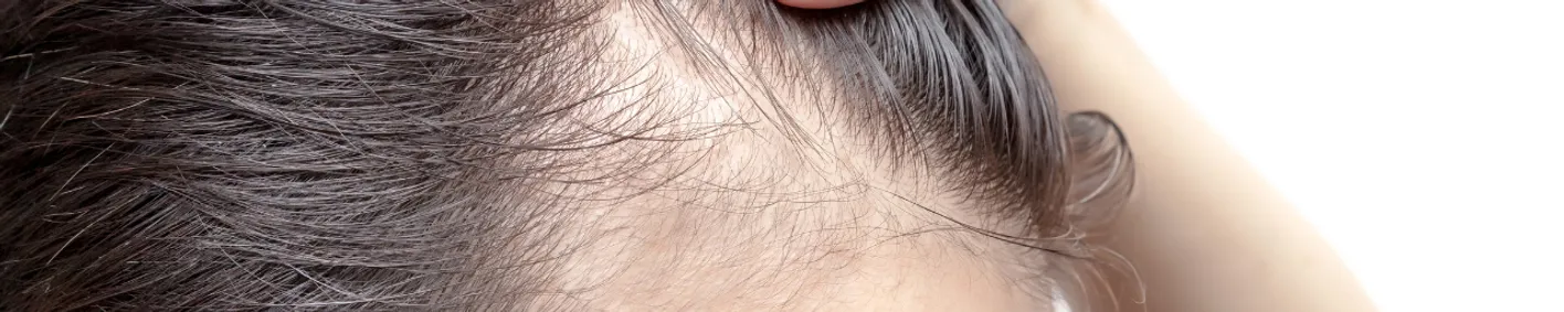 Female androgenetic alopecia: Causes and cure Female androgenetic alopecia: Causes and cure